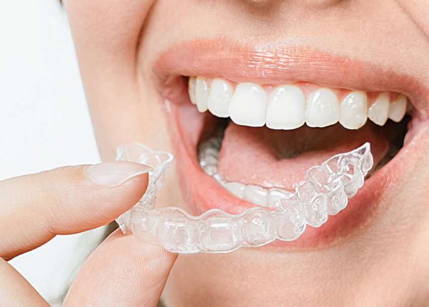 Close-up of clear aligners