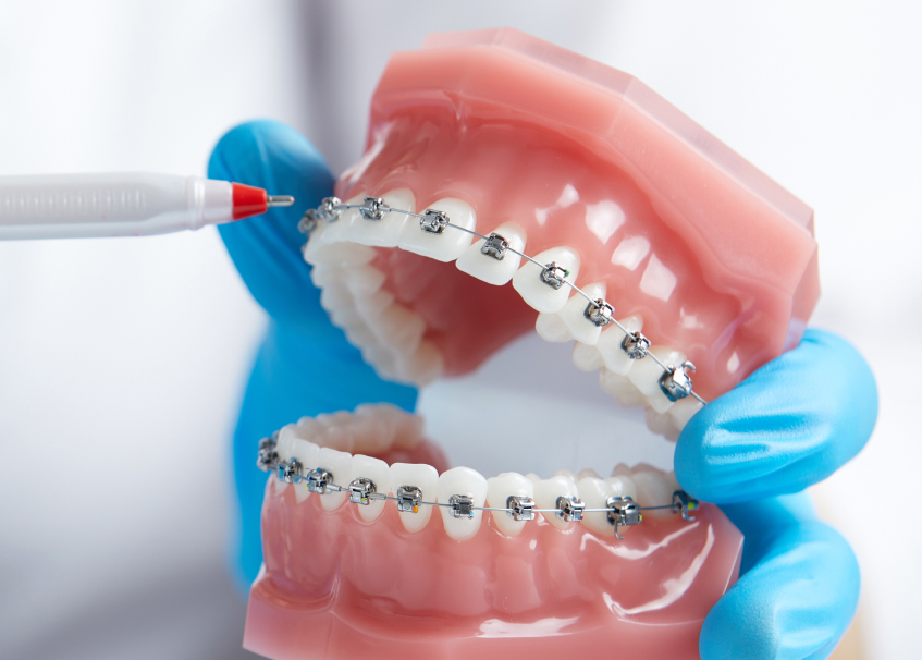 Close-up of metal braces on teeth