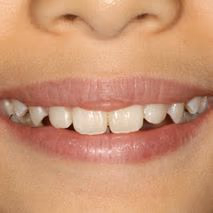 Patient smile after braces
