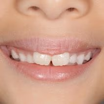 Patient smile before braces