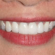 Patient smile after veneers