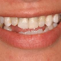 Patient smile before veneers
