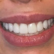 Patient smile after professional whitening