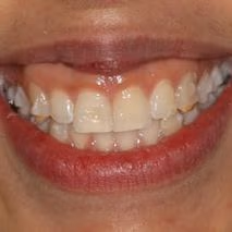 Patient smile before professional whitening
